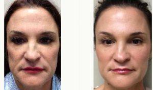 49 Year Old Woman Treated With Juvederm By Doctor Marguerite A. Germain, MD, Charleston Dermatologic Surgeon
