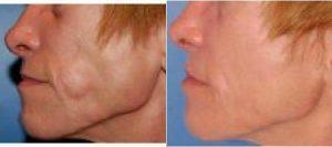 49 Year Old Woman Treated With Radiesse With Dr. Henry Wells, MD, Lexington Plastic Surgeon
