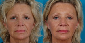 49-year-old Woman Treated With Botox. With Dr Eric Swanson, MD, Kansas City Plastic Surgeon