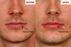 5 Cc Of Restylane In Lips By Dr. David Broadway, Denver Plastic Surgeon