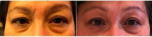 50 Year Old Woman Desire Brow And Forhead Lift With Doctor Susan F. Lin, MD, San Mateo OB-GYN