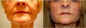 50 Year Old Woman Treated With Botox And Juvederm Ultra Plus Before And After By Dr Glen Brooks, MD, Springfield Plastic Surgeon