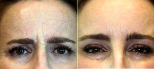 50 Year Old Woman Treated With Botox And Restylane With Dr. Laura Phan, MD, Los Gatos Physician
