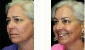 50 Year Old Woman Treated With Botox Before And After With Dr Kris M. Reddy, MD, FACS, West Palm Beach Plastic Surgeon