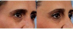50 Year Old Woman Treated With Botox By Dr. Brett S. Kotlus, MD, MS, New York Oculoplastic Surgeon