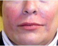 50 Year Old Woman Treated With Juvederm With Dr. Jeff Angobaldo, MD, Dallas Plastic Surgeon