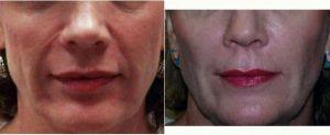 50 Year Old Woman Treated With Restylane For Scar Revision And Nasolabial Folds Before & After By Doctor Cheryl Perlis, MD, FACOG, Highland Park Physician