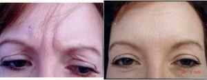 51 Year Old Woman Treated With Botox With Doctor Maria Atkins, DO, Portland Physician