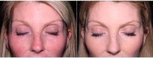 51 Year Old Woman Treated With Juvederm Before & After By Dr