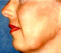 51 Year Old Woman Treated With Juvederm By Dr Craig R. Dufresne, MD, Chevy Chase Plastic Surgeon