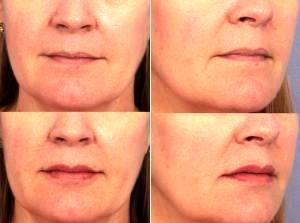 51 Year Old Woman Treated With Restylane Before & After With Doctor Grant Stevens, MD, Los Angeles Plastic Surgeon