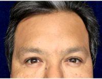 52 Year Old Man Treated With Botox By Dr Elizabeth Hernandez Cardona, MD, San Antonio Physician