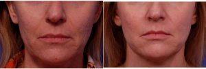 52 Year Old Woman Treated With Juvederm Before & After With Doctor Thomas J. Walker, MD, Atlanta Facial Plastic Surgeon