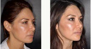 52 Year Old Woman Treated With Radiesse By Doctor Michael Elam, MD, Orange County Facial Plastic Surgeon