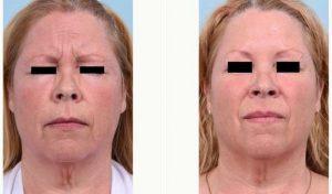 53 Year Old Woman Treated Facial Wrinkles With Botox While Maintaining Full Movement. Before And After By Dr Victor Chung, MD, San Diego Facial Plastic Surgeon