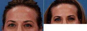 53 Year Old Woman Treated With Botox Before And After By Dr. William P. Adams, Jr., MD, Dallas Plastic Surgeon