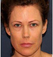 53 Year Old Woman Treated With Botox With Doctor William Groff, DO, San Diego Dermatologist