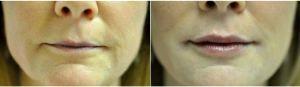 53 Year Old Woman Treated With Restylane Before & After By Dr Renuka Diwan, MD, Cleveland Dermatologic Surgeon