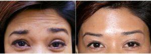 54 Year Old Woman Treated With Botox For Forehead Lines With Dr. David Yew, MD, Honolulu Physician