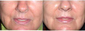 54 Year Old Woman Treated With Restylane Before & After With Dr Edward H. Bedrossian, Jr., MD, Philadelphia Oculoplastic Surgeon