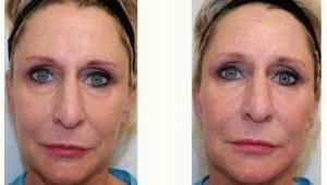 54 Year Old Woman Treated With Restylane In Tear Troughs, Cheek, Periocular, And PreJowl Sulcus Before & After With Doctor Steven F. Weiner, MD, Panama City Facial Plastic Surgeon