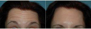 55 Year Old Woman Treated With Botox And Restylane With Dr Tracy Leong, MD, Carlsbad Dermatologic Surgeon