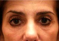 55 Year Old Woman Treated With Botox Before And After With Dr. Richard H. Bensimon, MD, Portland Plastic Surgeon