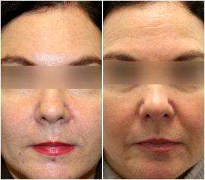 56 Year Old Female Received Botox To The Crow's Feet, Glabella And Forehead And Restylane To The Marionette Lines By Dr. Jessica Krant, Dermatologist In New York City, New York