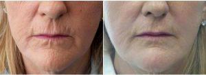 56 Year Old Woman Treated With Botox With Doctor Christine Hamori, MD, Boston Plastic Surgeon 823