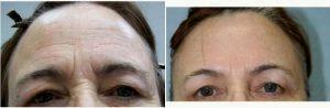 57 Year Old Woman Treated With Botox Before And After By Doctor F. Victor Rueckl, MD, Las Vegas Dermatologist