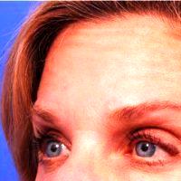57 Year Old Woman Treated With Botox - Treatment Areas Include Glabella, Crows Feet, Forehead With Dr Thomas J. Walker, MD, Atlanta Facial Plastic Surgeon