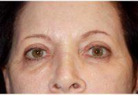 57 Year Old Woman Treated With Botox With Doctor Leonard Miller, MD, Brookline Plastic Surgeon