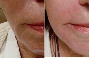 58 Year Old Woman Treated With Juvederm With Doctor Todd Christopher Hobgood, MD, Phoenix Facial Plastic Surgeon