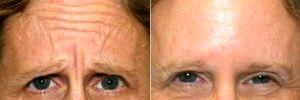 60 Year Old Woman Treated Botox For Frown Lines With Dr. Peterson Pierre, MD, Thousand Oaks Dermatologist