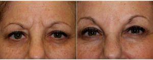 61 Year Old Woman Treated With Juvederm And Botox Before & After By Dr. Marc Cohen, MD, Philadelphia Oculoplastic Surgeon