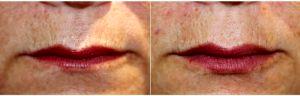 61 Year Old Woman Treated With Restylane™ To Enhance Lips. Before & After With Dr James R. Gordon, MD, FACS, FAAO, New York Oculoplastic Surgeon