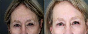 61 Year-old Who Had 48 Units Of Botox To Her Crows Feet And Glabella By Patti Flint MD PC, MD, Scottsdale AZ Plastic Surgeon