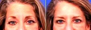 62 Year Old Woman Treated With Botox - Treatment Areas Include Forehead, Crows Feet, And Bunny Lines By Doctor Thomas J. Walker, MD, Atlanta Facial Plastic Surgeon