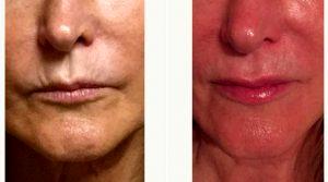62 Year Old Woman Treated With Juvederm Ultra And Volbella