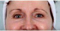 64 Year Old Woman Treated With Botox By Dr William Marshall Guy, MD, The Woodlands Facial Plastic Surgeon