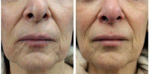 67 Year Old Woman Treated With Restylane Silk To Perioral Lines Before & After With Dr. Neil Sadick, MD, New York Dermatologic Surgeon