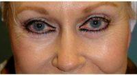 69 Year Old Woman Treated With Botox With Dr. William Marshall Guy, MD, The Woodlands Facial Plastic Surgeon
