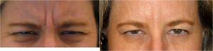 7 Days After Botox To The Glabella At Always Beautiful Medspa, Medical Spa In Aurora, Colorado