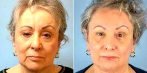 70 Year Old Woman Treated With ArteFill By Dr Landon Pryor, MD, FACS, Rockford Plastic Surgeon