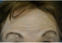 72 Year Old Woman Treated With Botox By Dr. Richard G. Schwartz, MD, West Palm Beach Plastic Surgeon