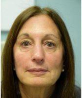73 Year Old Woman Treated With Dysport By Dr Jeffrey B. Wise, MD, FACS, Wayne Facial Plastic Surgeon