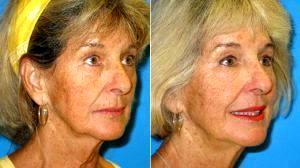 74 Year Old Woman Treated For Loss Of Facial Volume With Sculptra By Doctor Stephen Prendiville, MD, Fort Myers Facial Plastic Surgeon