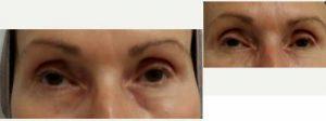 74 Year Old Woman Treated With Restylane For Her Tear Troughs Before & After By Doctor Steven F. Weiner, MD, Panama City Facial Plastic Surgeon
