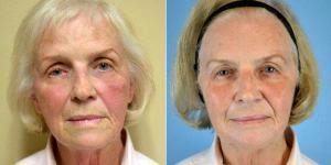 75 And Up Year Old Woman Treated With ArteFill With Doctor Landon Pryor, MD, FACS, Rockford Plastic Surgeon