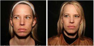 A Few Units Of Botox In Her Masseter Muscles By Dr. David Verebelyi, MD, Englewood, CO Plastic Surgeon